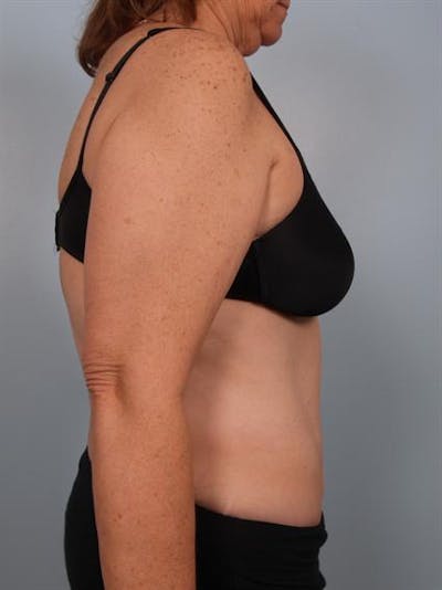 Tummy Tuck Before & After Gallery - Patient 1310780 - Image 6