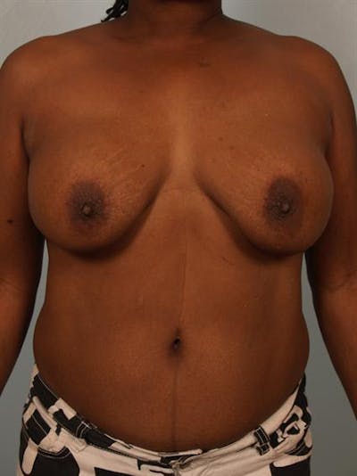 Complex Breast Revision Before & After Gallery - Patient 1310781 - Image 1