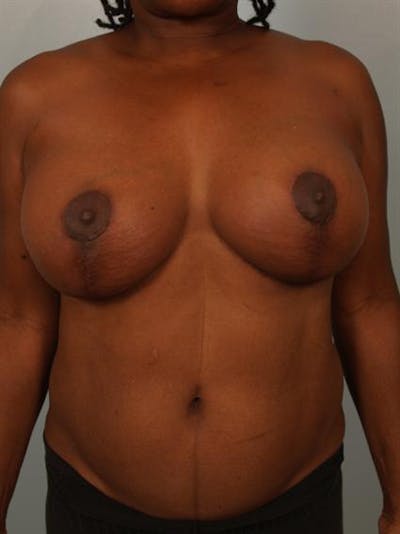 Complex Breast Revision Before & After Gallery - Patient 1310781 - Image 2