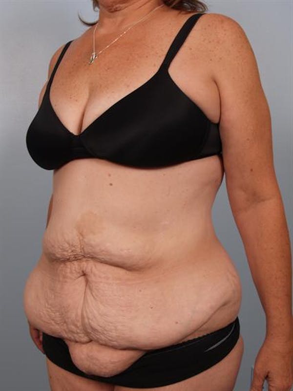 Power Assisted Liposuction Before & After Gallery - Patient 1310783 - Image 3