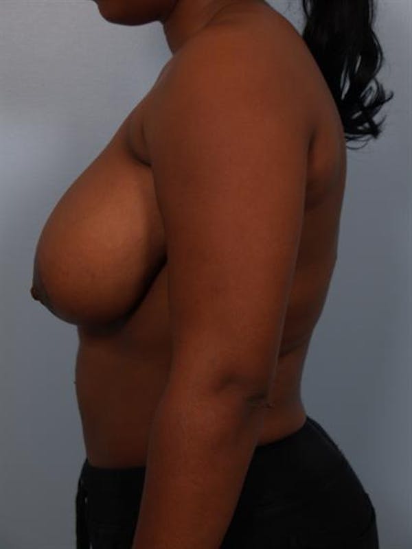 Breast Reduction Before & After Gallery - Patient 1310785 - Image 5