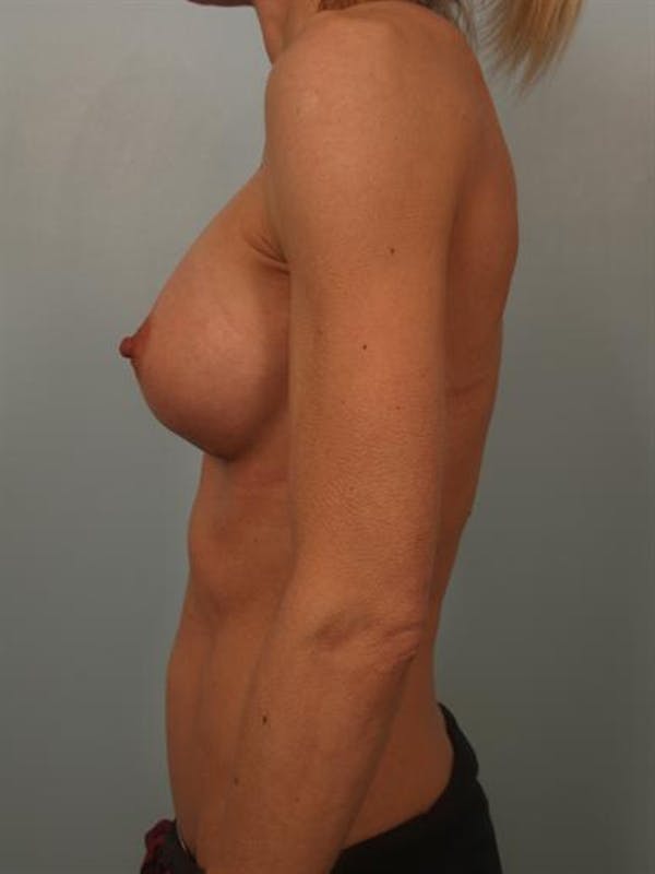 Breast Augmentation Gallery - Patient 1310786 - Image 6