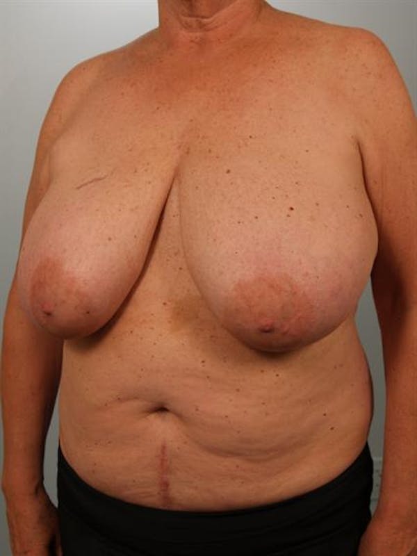 Breast Reduction Before & After Gallery - Patient 1310793 - Image 3