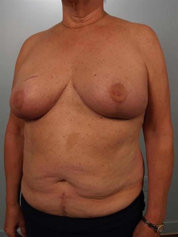 Breast Reduction Before & After Gallery - Patient 1310793 - Image 4