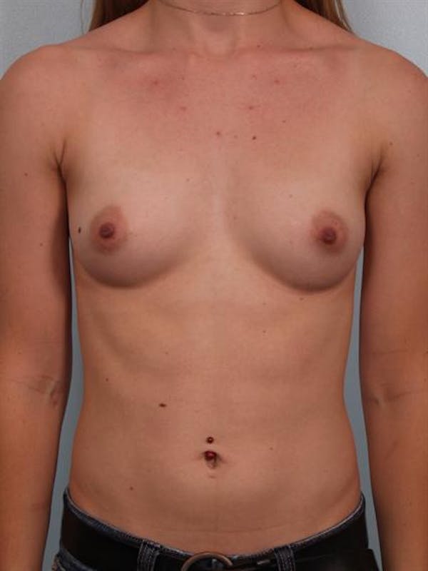Breast Augmentation Before & After Gallery - Patient 1310796 - Image 1