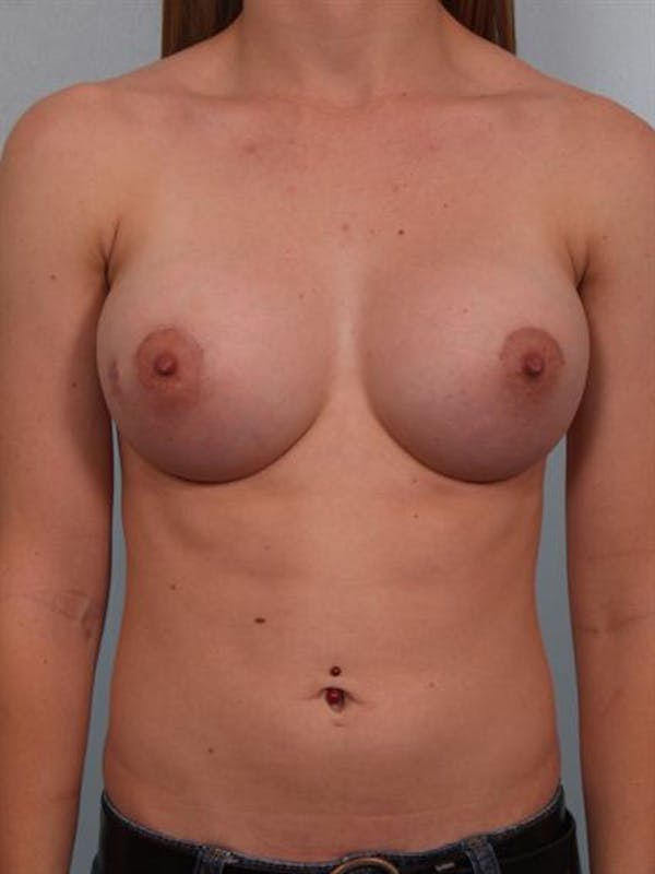 Breast Augmentation Gallery - Patient 1310796 - Image 2