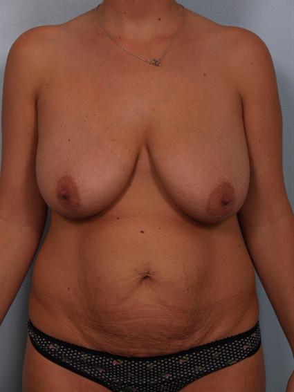 Image1 - Before image of Tummy Tuck in Beverly Hills by Dr. Cohen.