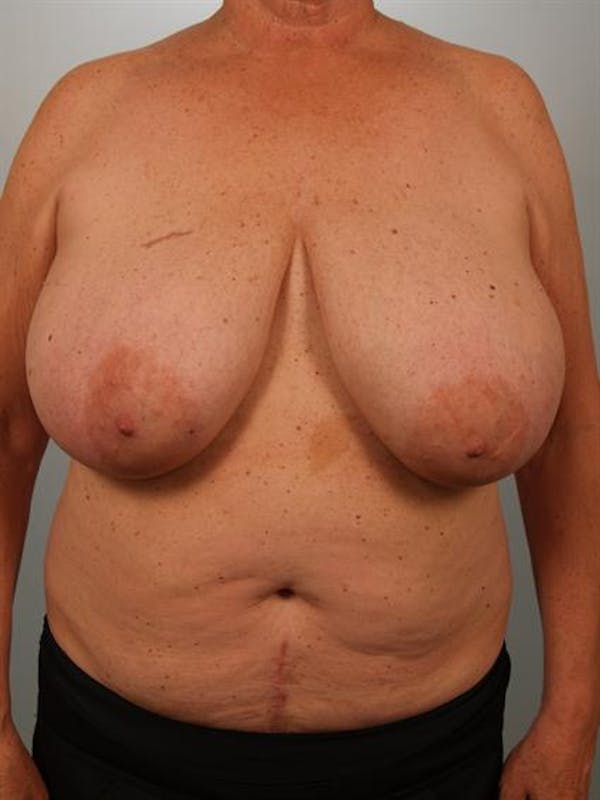 Breast Reduction Before & After Gallery - Patient 1310793 - Image 1