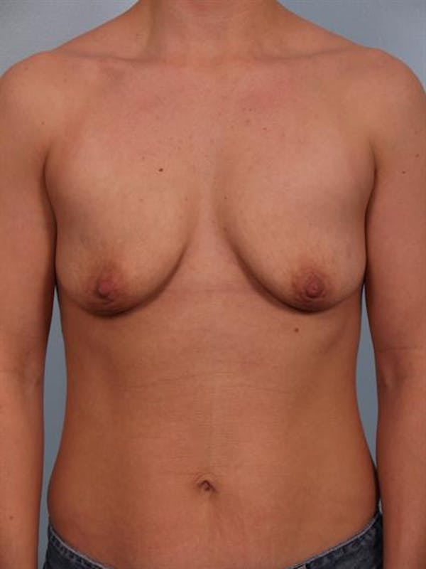 Breast Lift Gallery - Patient 1310797 - Image 1