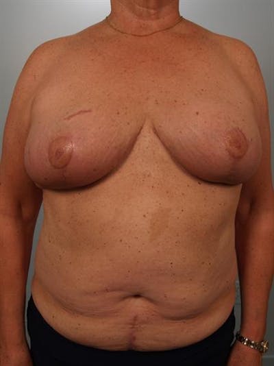 Breast Reduction Before & After Gallery - Patient 1310793 - Image 2