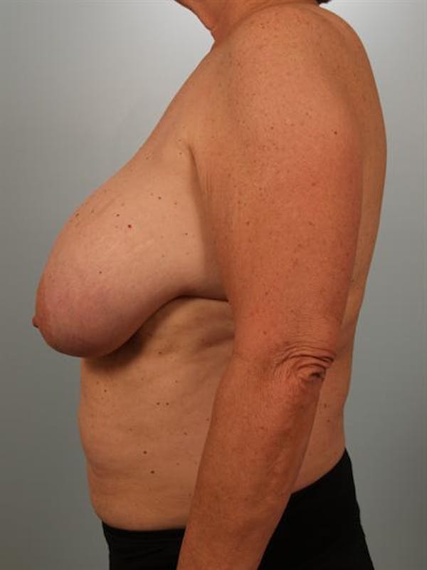 Breast Reduction Before & After Gallery - Patient 1310793 - Image 5