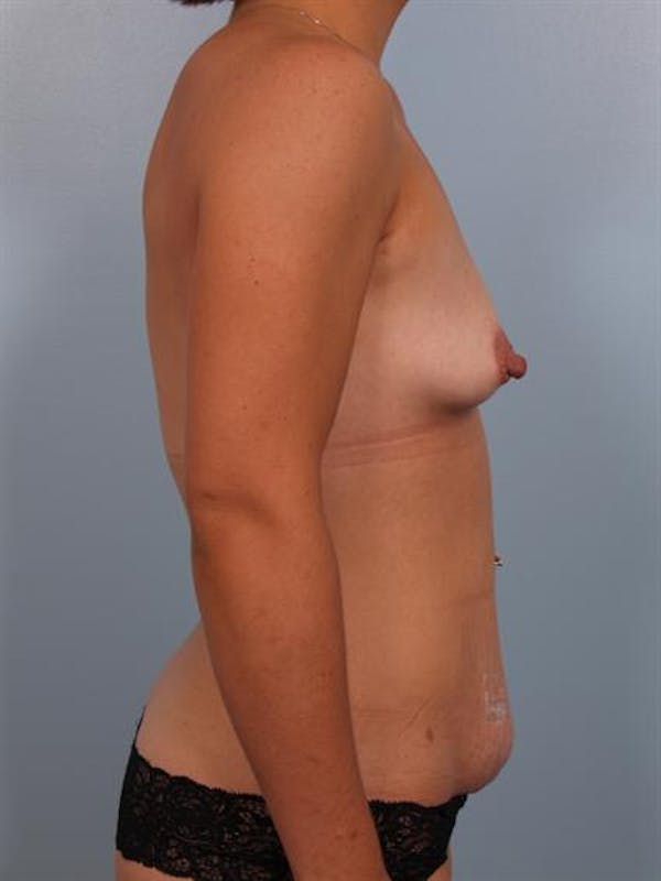 Mommy Makeover Before & After Gallery - Patient 1310794 - Image 7