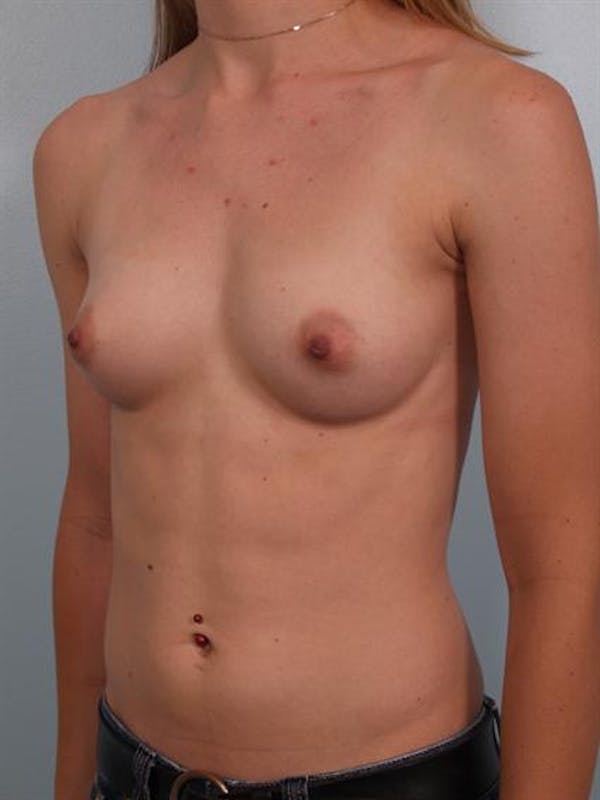 Breast Augmentation Before & After Gallery - Patient 1310796 - Image 5