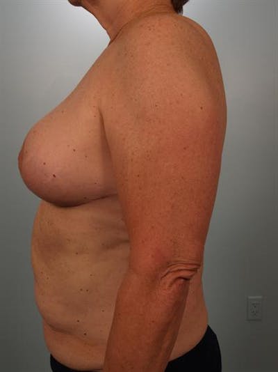 Breast Reduction Before & After Gallery - Patient 1310793 - Image 6