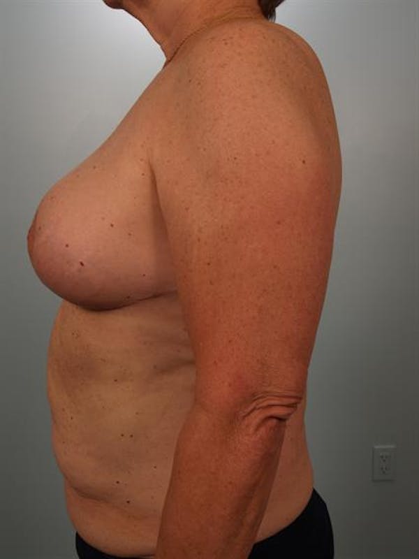Breast Reduction Before & After Gallery - Patient 1310793 - Image 6