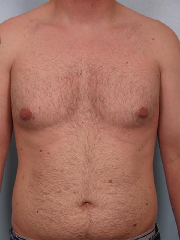 Power Assisted Liposuction Before & After Gallery - Patient 1310803 - Image 3