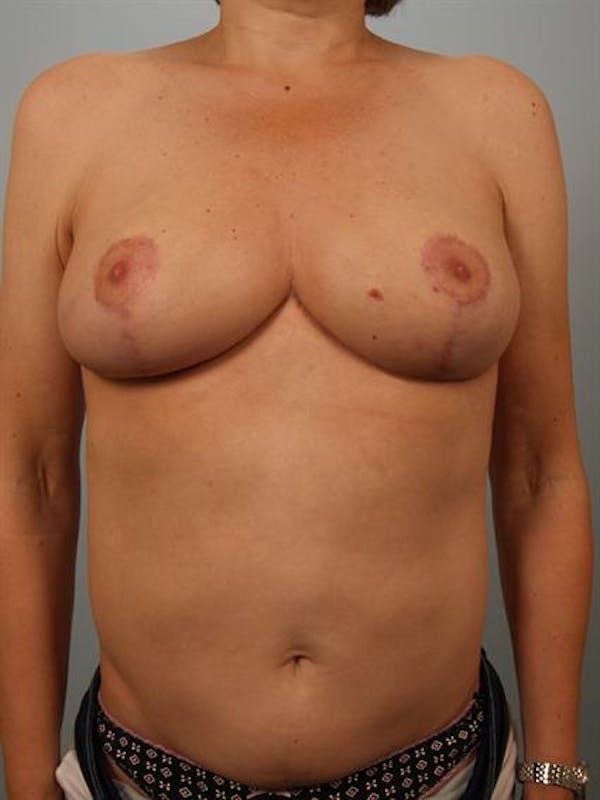 Breast Reduction Before & After Gallery - Patient 1310802 - Image 2