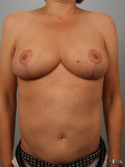 Breast Reduction Before & After Gallery - Patient 1310802 - Image 2