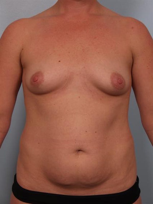 Breast Augmentation Before & After Gallery - Patient 1310804 - Image 3