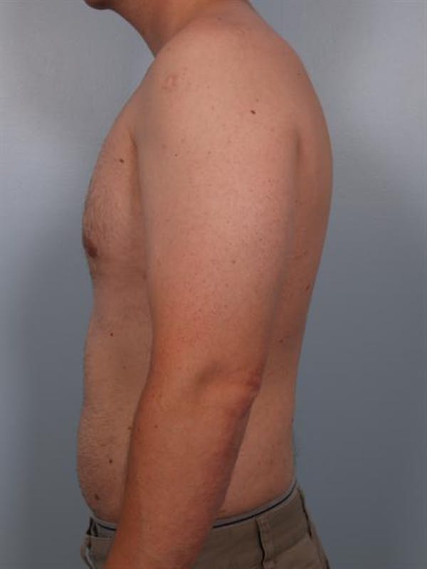 Power Assisted Liposuction Before & After Gallery - Patient 1310803 - Image 6