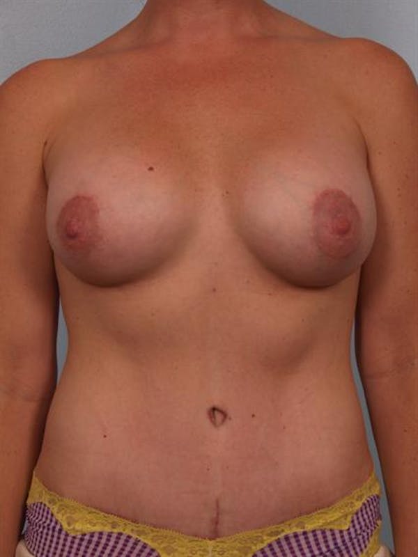 Breast Augmentation Before & After Gallery - Patient 1310804 - Image 4