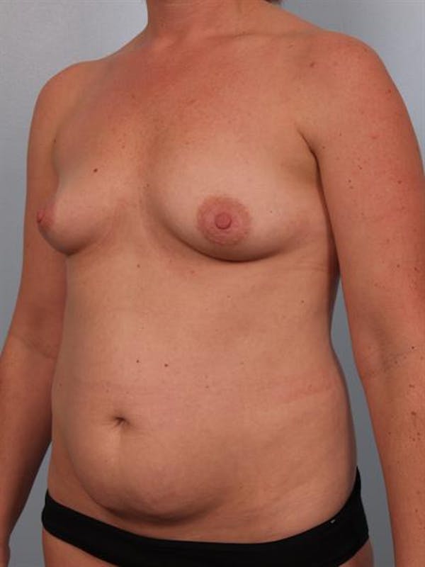 Breast Augmentation Before & After Gallery - Patient 1310804 - Image 5