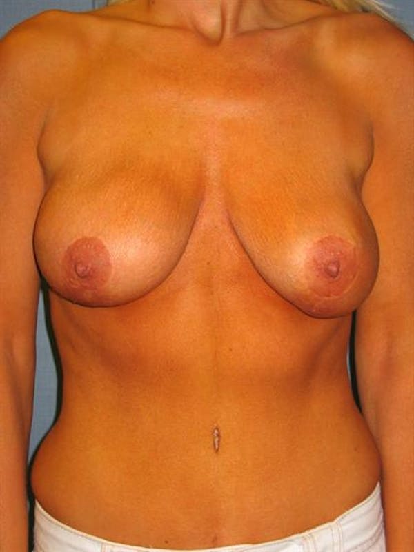 Breast Lift Before & After Gallery - Patient 1310805 - Image 5