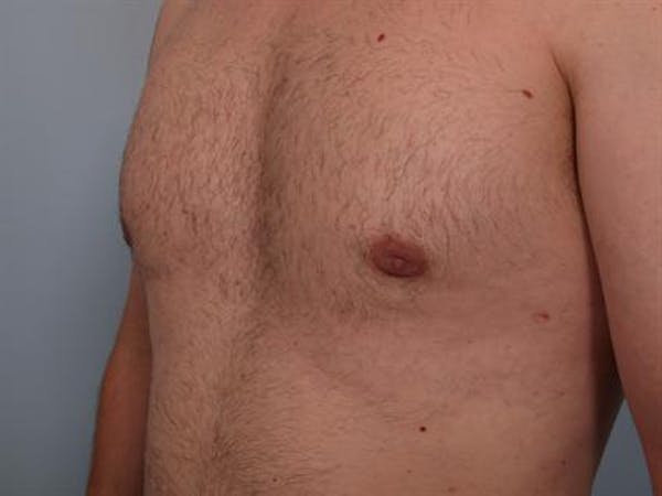 Power Assisted Liposuction Before & After Gallery - Patient 1310803 - Image 8