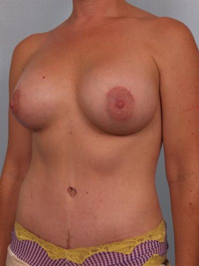 Breast Augmentation Before & After Gallery - Patient 1310804 - Image 6