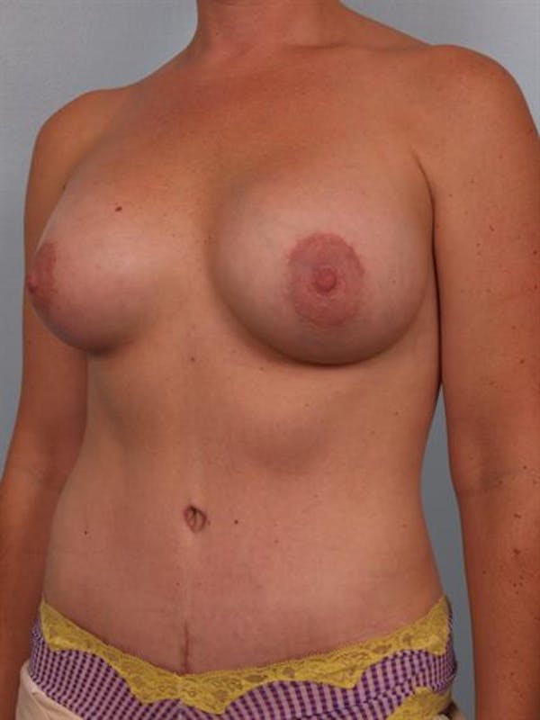 Breast Augmentation Before & After Gallery - Patient 1310804 - Image 6