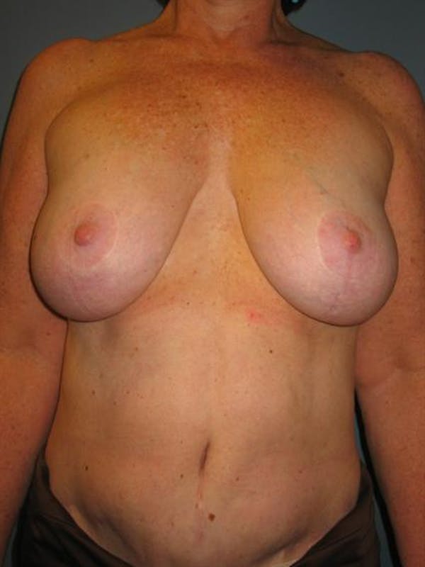 Breast Reduction Gallery - Patient 1310810 - Image 1