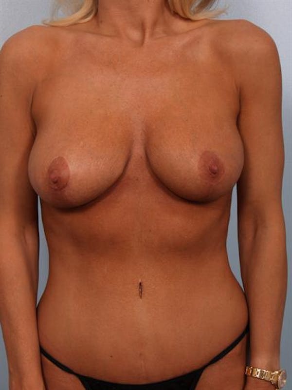 Breast Lift Before & After Gallery - Patient 1310805 - Image 6