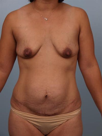 Mommy Makeover Before & After Gallery - Patient 1310808 - Image 1