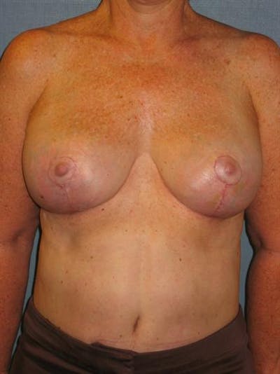 Breast Reduction Before & After Gallery - Patient 1310810 - Image 2