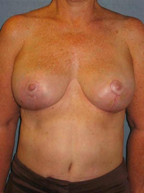 Breast Reduction Before & After Gallery - Patient 1310810 - Image 2