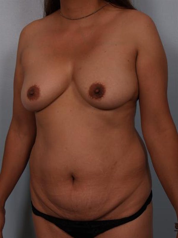 Tummy Tuck Before & After Gallery - Patient 1310809 - Image 3