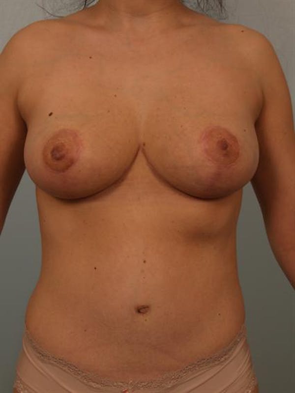 Power Assisted Liposuction Before & After Gallery - Patient 1310807 - Image 2