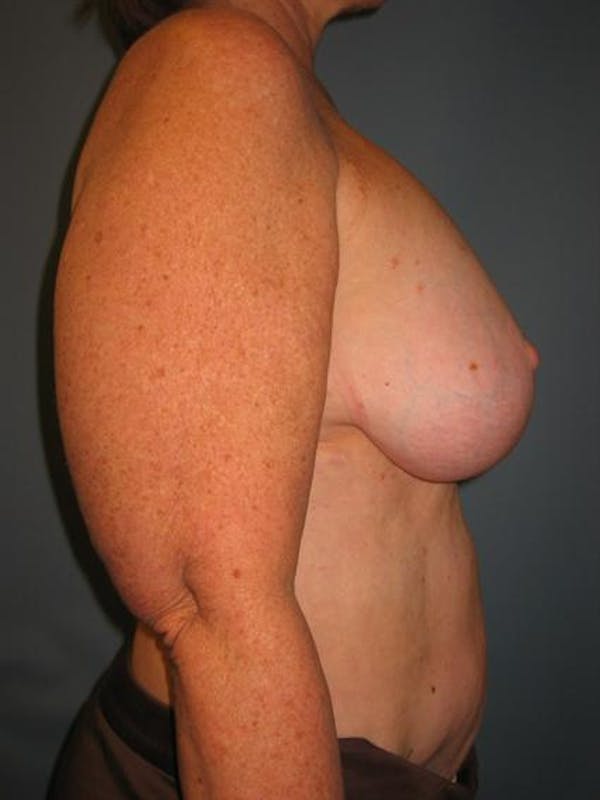Breast Reduction Before & After Gallery - Patient 1310810 - Image 3