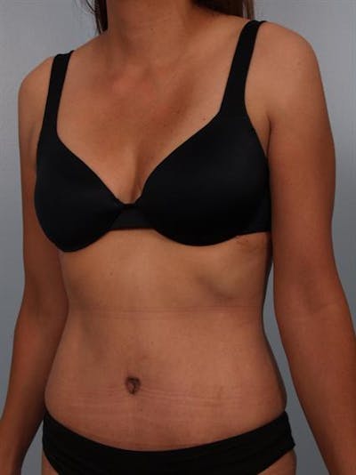 Tummy Tuck Before & After Gallery - Patient 1310809 - Image 4