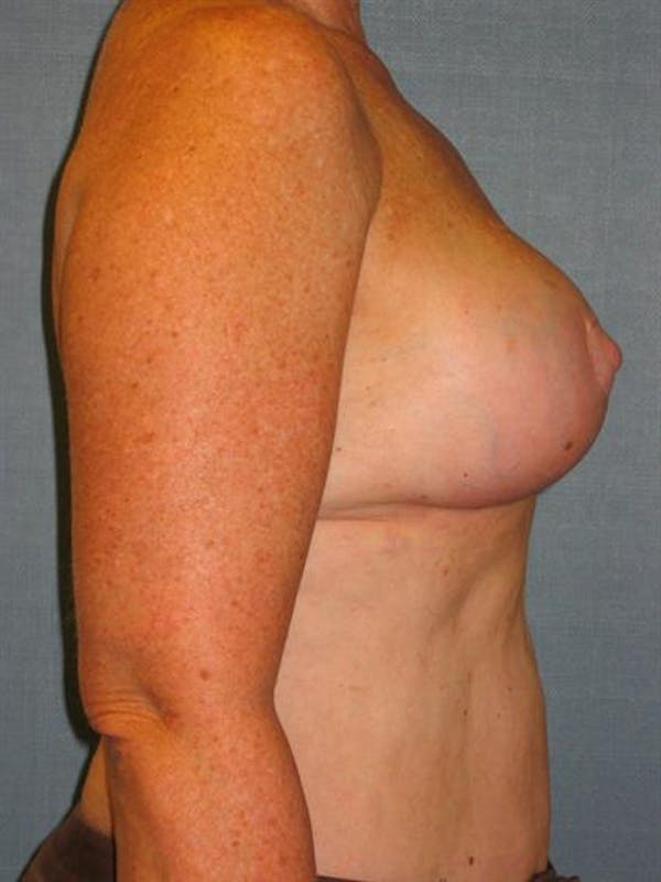 Breast Reduction Before & After Gallery - Patient 1310810 - Image 4