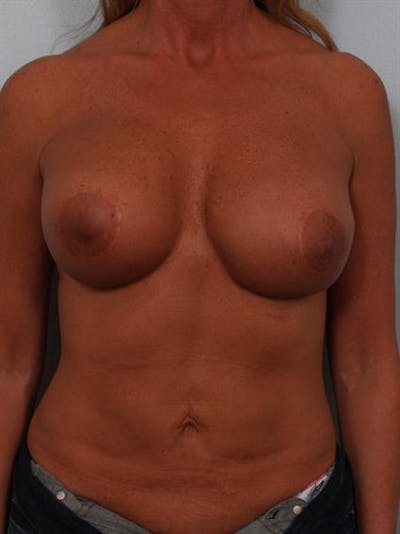 Complex Breast Revision Before & After Gallery - Patient 1310811 - Image 1