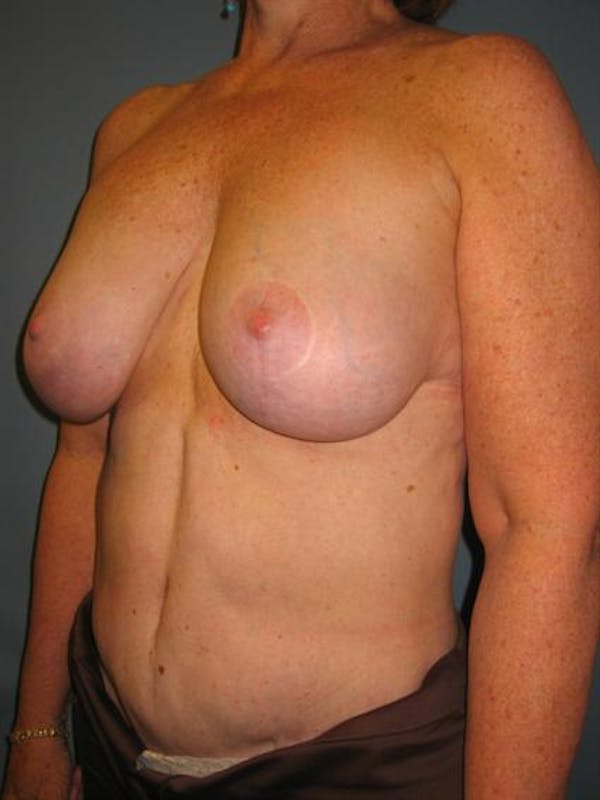 Breast Reduction Before & After Gallery - Patient 1310810 - Image 5