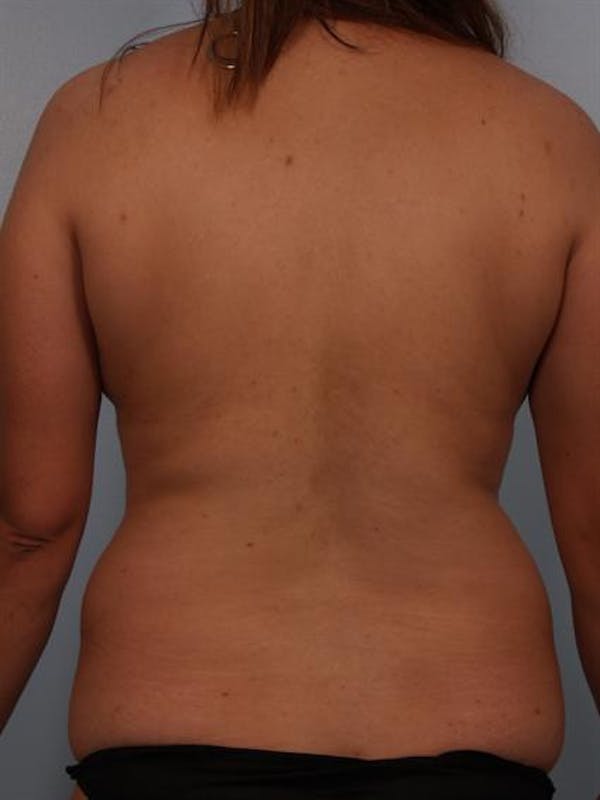 Tummy Tuck Before & After Gallery - Patient 1310809 - Image 7