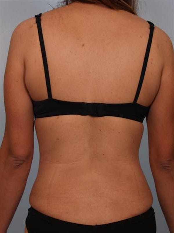 Tummy Tuck Before & After Gallery - Patient 1310809 - Image 8
