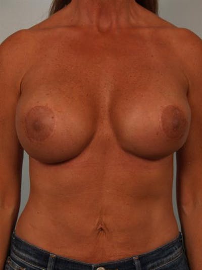 Complex Breast Revision Before & After Gallery - Patient 1310811 - Image 2