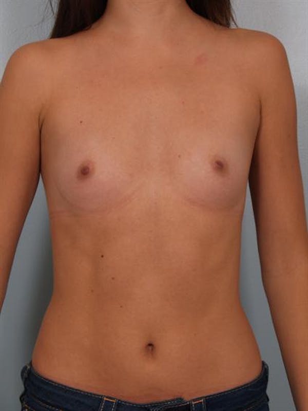 Breast Augmentation Gallery - Patient 1310814 - Image 3
