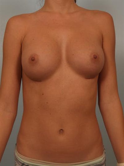 Breast Augmentation Gallery - Patient 1310814 - Image 4