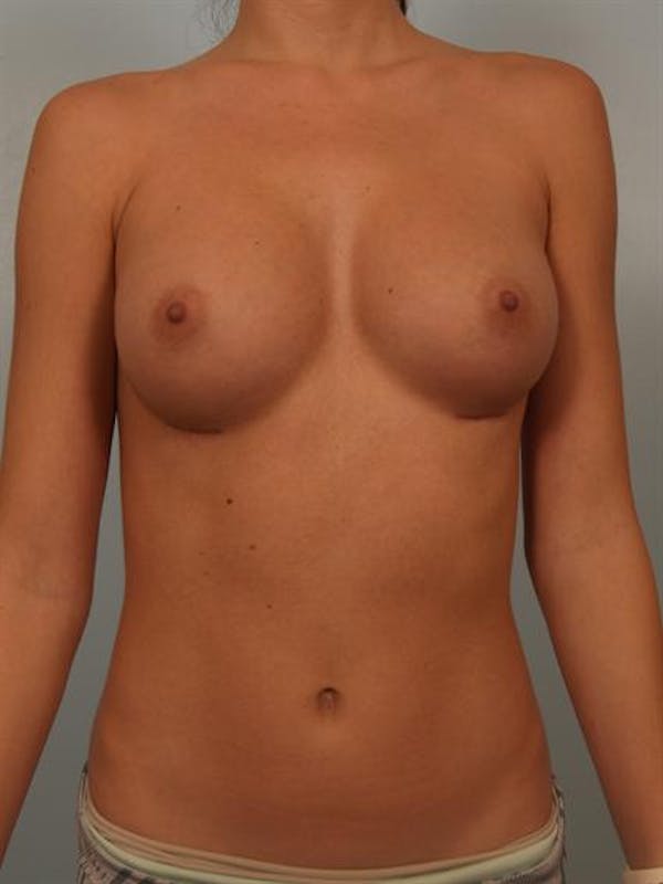Breast Augmentation Before & After Gallery - Patient 1310814 - Image 4