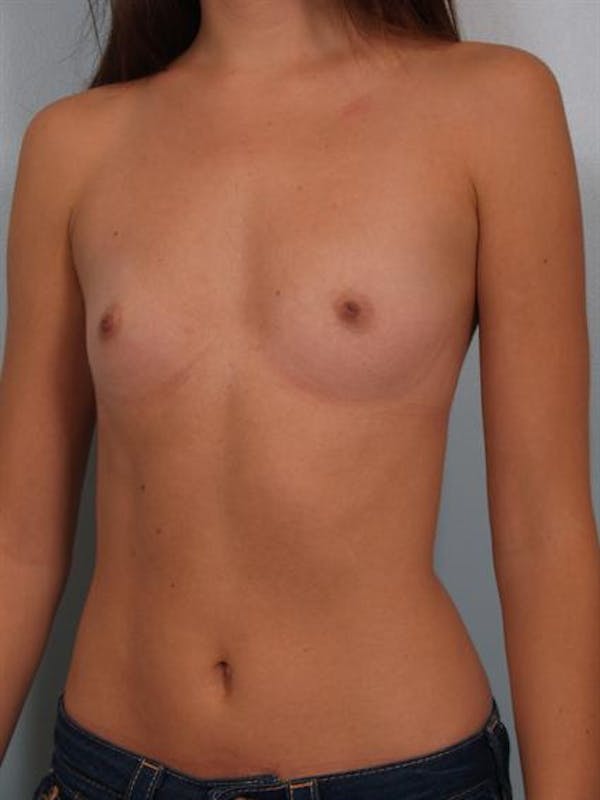 Breast Augmentation Before & After Gallery - Patient 1310814 - Image 5