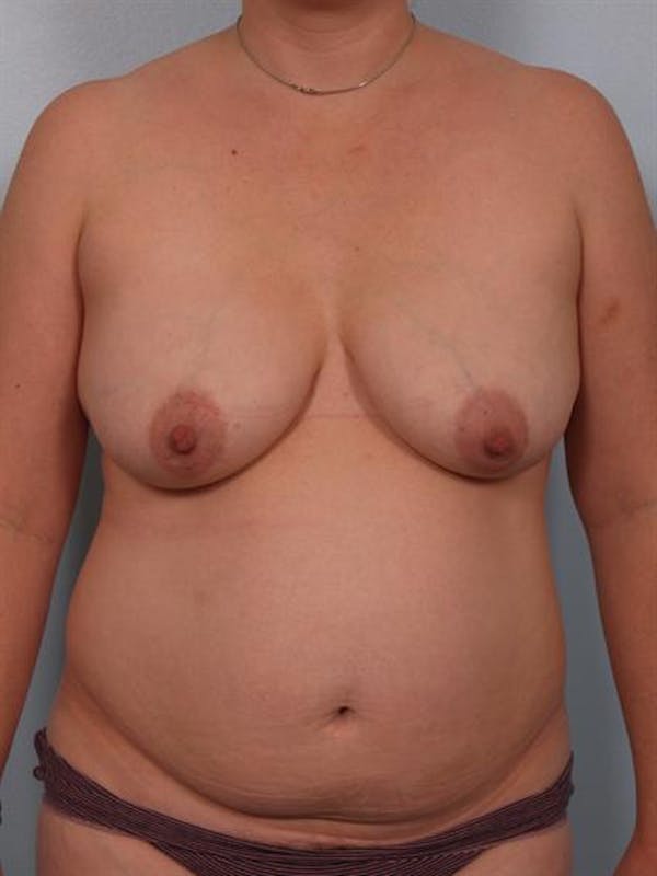 Mommy Makeover Before & After Gallery - Patient 1310816 - Image 1